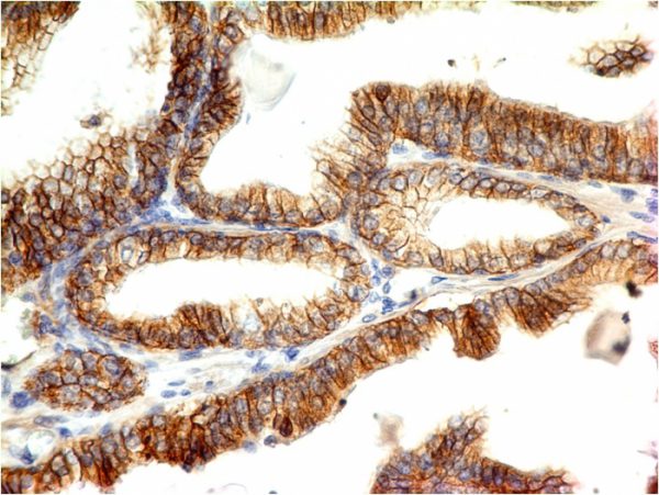 Formalin-fixed, paraffin-embedded colon carcinoma stained with E-Cadherin Mouse Monoclonal Antibody (CDH1/1525).