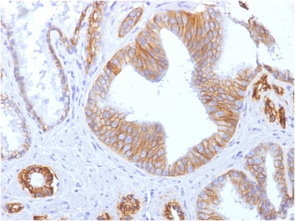 Formalin-fixed, paraffin-embedded human prostate carcinoma stained with E-Cadherin Mouse Monoclonal Antibody(SPM471).