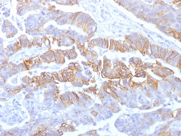 Formalin-fixed, paraffin-embedded human colon carcinoma stained with E-Cadherin Mouse Recombinant Monoclonal Antibody (rCDH1/1525).