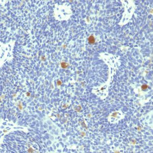 Formalin-fixed, paraffin-embedded human Cervix stained with HPV-18 Mouse Monoclonal Antibody (HPV18/1297).