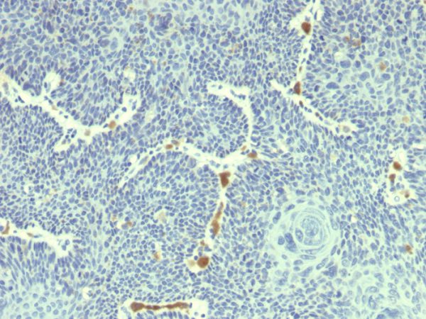 Formalin-fixed, paraffin-embedded human Cervix stained with HPV-18 Mouse Monoclonal Antibody (HPV18/1297).