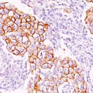 Formalin-fixed, paraffin-embedded human Breast Carcinoma stained with Phosphotyrosine Mouse Monoclonal Antibody (PY20).