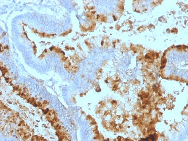 Formalin-fixed, paraffin-embedded human Colon Carcinoma stained with Lewis A Monoclonal Antibody (7LE).