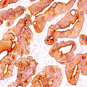 Formalin-fixed, paraffin-embedded human Colon Carcinoma stained with Multi Cytokeratin Mouse Monoclonal Antibody (C11).