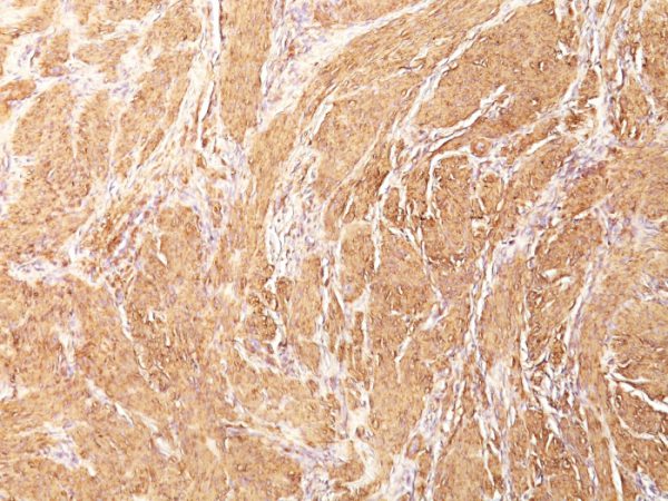Formalin-fixed, paraffin-embedded human Leiomyosarcoma stained with Muscle Specific Actin Mouse Monoclonal Antibody (HHF35).
