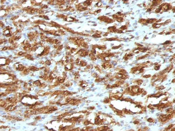 Formalin-fixed, paraffin-embedded human Rhabdomyosarcoma stained with Muscle Specific Actin Mouse Monoclonal Antibody (HHF35).