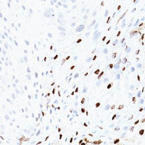 Formalin-fixed, paraffin-embedded human Cervix stained with HPV-16 Monoclonal Antibody (SPM405)