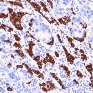 Formalin-fixed, paraffin-embedded human Liver stained with Hepatocyte Specific Antigen Mouse Monoclonal Antibody (OCH1E5).