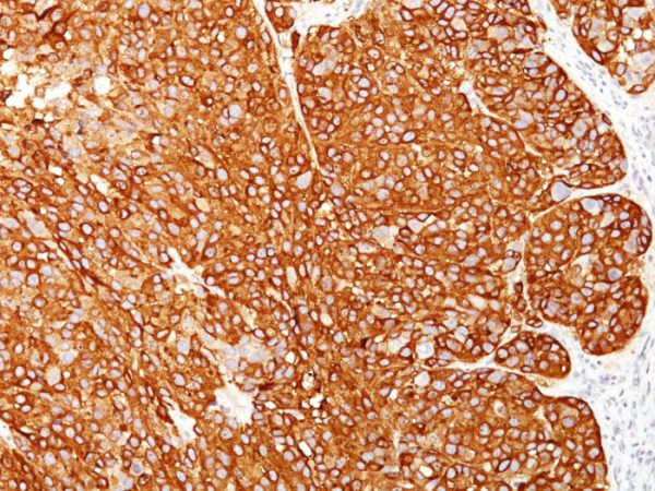 Formalin-fixed, paraffin-embedded human Melanoma stained with Melanoma Marker Monoclonal Antibody (M2-7C10 + M2-9E3 + T311 + HMB45).