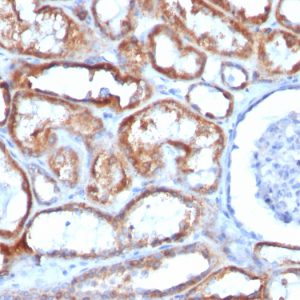 Formalin-fixed, paraffin-embedded human Renal Cell Carcinoma stained with Mitochondria Mouse Monoclonal Antibody (113-1).