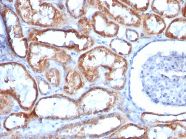Formalin-fixed, paraffin-embedded human Renal Cell Carcinoma stained with Mitochondria Mouse Monoclonal Antibody (113-1).