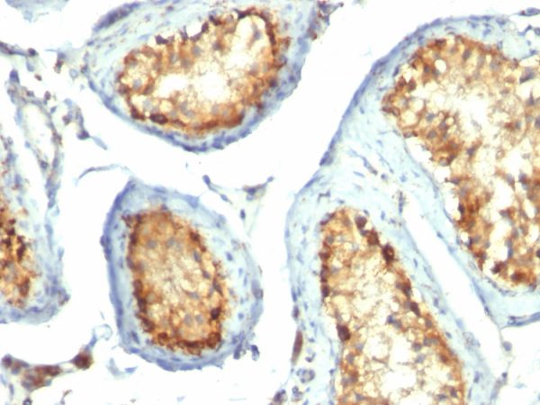 Formalin-fixed, paraffin-embedded human Testicular Carcinoma stained with Mitochondria Mouse Monoclonal Antibody (113-1).