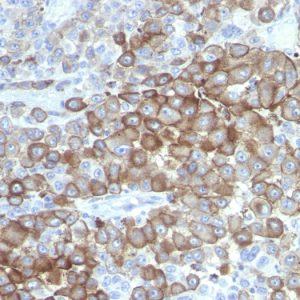 Formalin-fixed, paraffin-embedded human Melanoma stained with PNL2 Mouse Monoclonal Antibody.