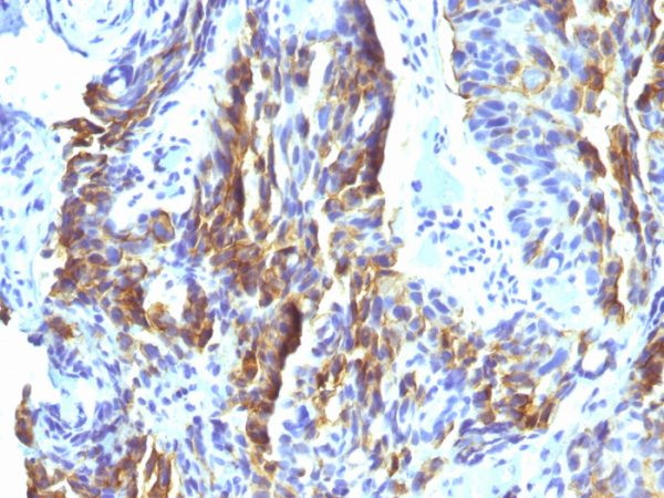 Formalin-fixed, paraffin-embedded human Tongue stained with Melanoma Monoclonal Antibody (KBA.62).
