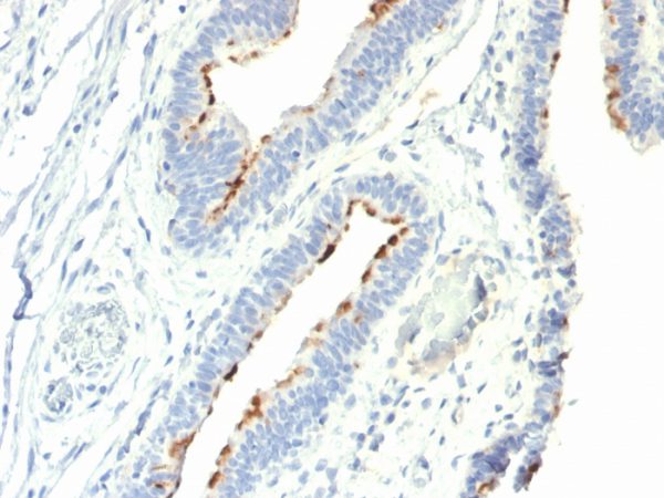 Formalin-fixed, paraffin-embedded human Colon Carcinoma stained with T-F Antigen / CD176 Mouse Monoclonal Antibody (A78-G/A7).
