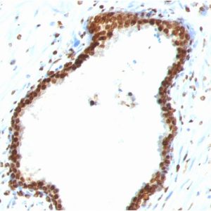 Formalin-fixed, paraffin-embedded human Colon Carcinoma stained with Double Stranded DNA Mouse Monoclonal Antibody (121-3)
