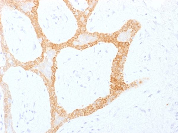 Formalin-fixed, paraffin-embedded human Colon Carcinoma stained with Cytokeratin 5/8 Monoclonal Antibody (C-50).