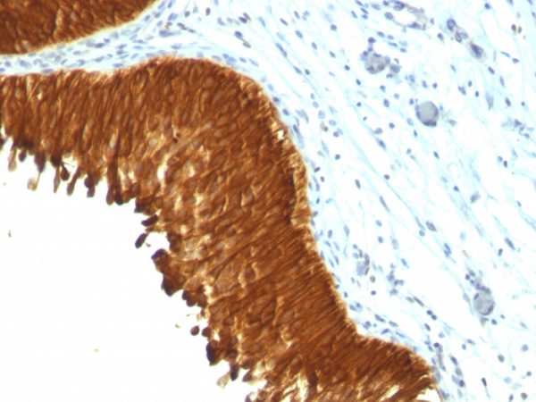Formalin-fixed, paraffin-embedded human Bladder Carcinoma stained with Multi Cytokeratin Monoclonal Antibody (KRT/457).