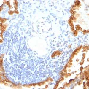 Formalin-fixed, paraffin-embedded human Lung Carcinoma stained with Cytokeratin 8/18 Monoclonal Antibody (KRT8/803 + KRT18/835).