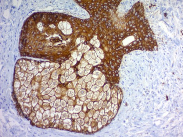 Formalin-fixed, paraffin-embedded human basal cell carcinoma stained with Pan-Cytokeratin Mouse Monoclonal Antibody (PAN-CK).
