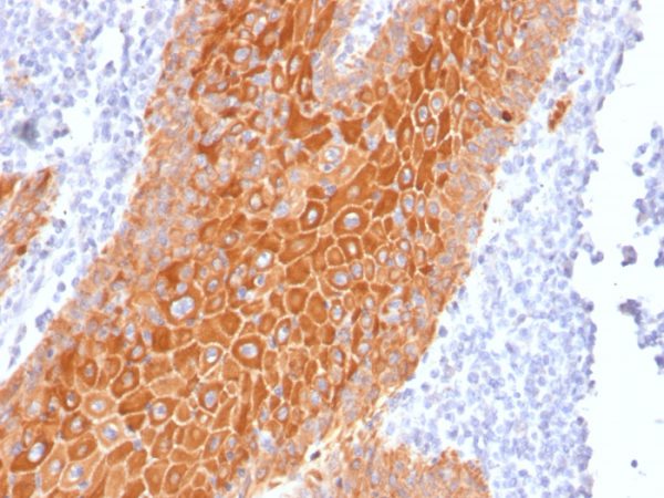 Formalin-fixed, paraffin-embedded human squamous cell carcinoma stained with Pan-Cytokeratin Mouse Monoclonal Antibody (PAN-CK).