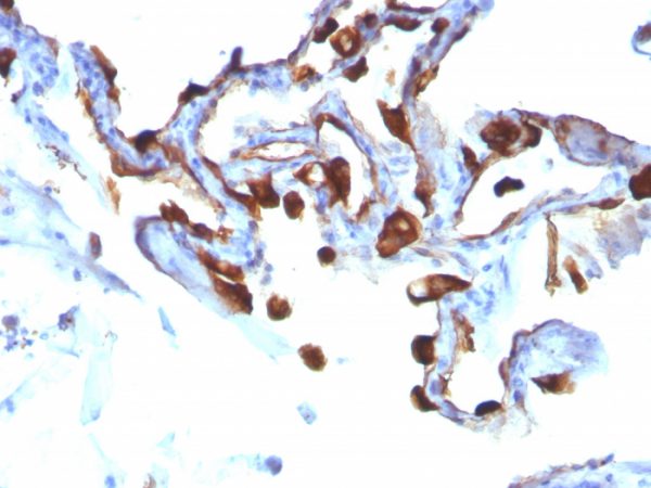 Formalin-fixed, paraffin-embedded human Lung Carcinoma stained with Cytokeratin 8/18 Monoclonal Antibody (C-51).
