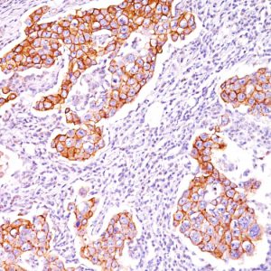 Formalin-fixed, paraffin-embedded human Breast Carcinoma stained with Phosphotyrosine Monoclonal Antibody (SPM102).