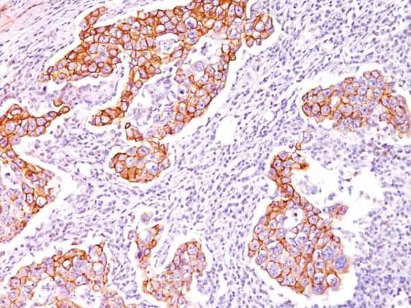 Formalin-fixed, paraffin-embedded human Breast Carcinoma stained with Phosphotyrosine Monoclonal Antibody (SPM102).