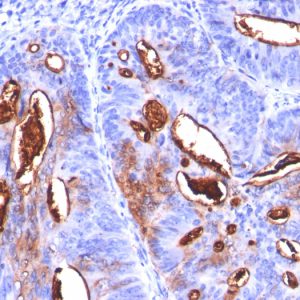 Formalin-fixed, paraffin-embedded human Colon Carcinoma stained with CA19-9 Monoclonal Antibody (SPM588).