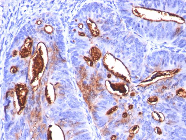 Formalin-fixed, paraffin-embedded human Colon Carcinoma stained with CA19-9 Monoclonal Antibody (SPM588).