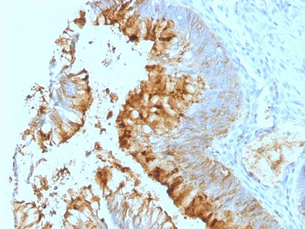 Formalin-fixed, paraffin-embedded human Colon Carcinoma stained with Lewis A Monoclonal Antibody (SPM279).