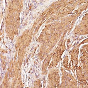 Formalin-fixed, paraffin-embedded human Leiomyosarcoma stained with Muscle Specific Actin Monoclonal Antibody (SPM160)