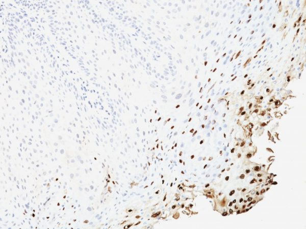 Formalin-fixed, paraffin-embedded human Cervix stained with HPV-16 Monoclonal Antibody (SPM257)