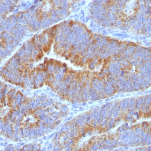 Formalin-fixed, paraffin-embedded human Colon Carcinoma stained with Thomsen-Friedenreich Monoclonal Antibody (SPM320) at 4ug/ml. Antigen retrieval in 10mM Citrate buffer, pH 6.0; ABC detection system with DAB Chromogen. Note Cell Surface staining of epithelial cells.