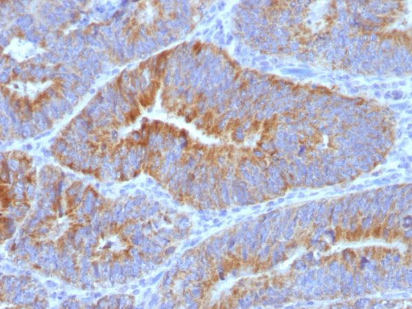 Formalin-fixed, paraffin-embedded human Colon Carcinoma stained with Thomsen-Friedenreich Monoclonal Antibody (SPM320) at 4ug/ml. Antigen retrieval in 10mM Citrate buffer, pH 6.0; ABC detection system with DAB Chromogen. Note Cell Surface staining of epithelial cells.
