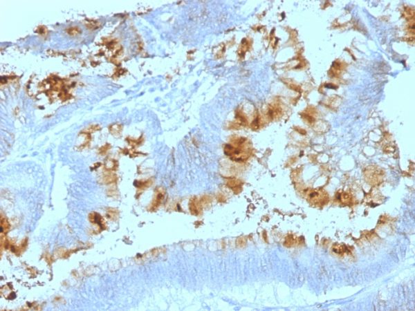 Formalin-fixed, paraffin-embedded human Colon Carcinoma stained with Lewis A Monoclonal Antibody (SPM522).