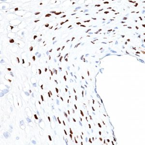 Formalin-fixed, paraffin-embedded human Cervix stained with HPV-16 Monoclonal Antibody (HPV16L1/1058)