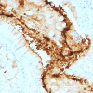 Formalin-fixed, paraffin-embedded human Colon Carcinoma stained with Lewis Y Mouse Monoclonal Antibody (A70-A/A9).