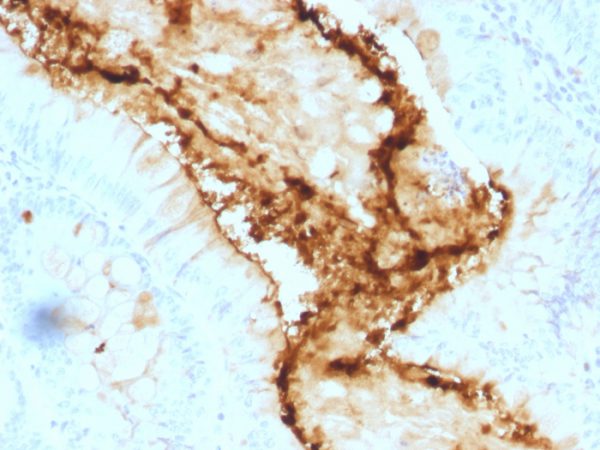 Formalin-fixed, paraffin-embedded human Colon Carcinoma stained with Lewis Y Mouse Monoclonal Antibody (A70-A/A9).