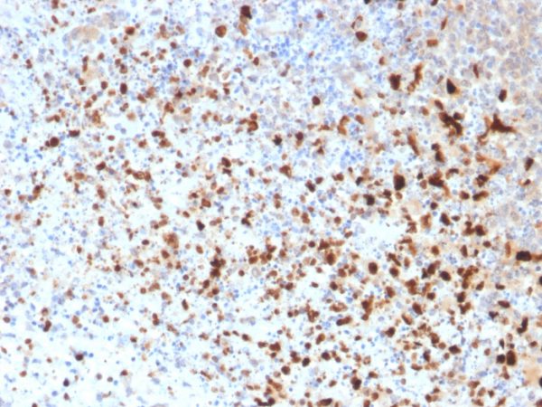 Formalin-fixed, paraffin-embedded human Cervix stained with HSV1 Mouse Monoclonal Antibody (10A3).