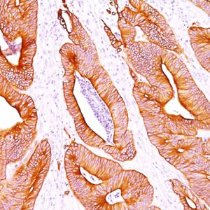 Formalin-fixed, paraffin-embedded human Colon Carcinoma stained with pan Cytokeratin Monoclonal Antibody cocktail (AE-1/AE3).