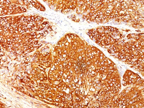 Formalin-fixed, paraffin-embedded human Melanoma stained with Melanoma Marker Monoclonal Antibody (A103 + T311 + HMB45).
