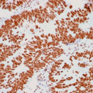 Formalin-fixed, paraffin-embedded human Colon Carcinoma stained with Nucleolar Mouse Monoclonal Antibody (NM95).