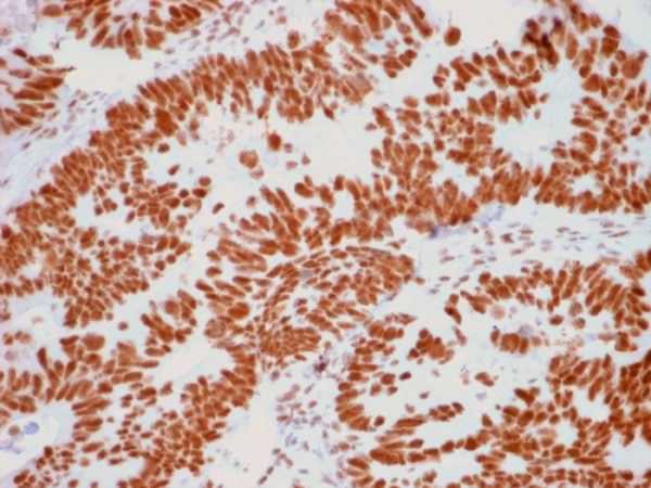 Formalin-fixed, paraffin-embedded human Colon Carcinoma stained with Nucleolar Mouse Monoclonal Antibody (NM95).