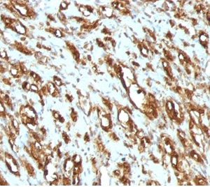 Formalin-fixed, paraffin-embedded human Rhabdomyosarcoma stained with Muscle Specific Actin Mouse Monoclonal Antibody (MSA/953).