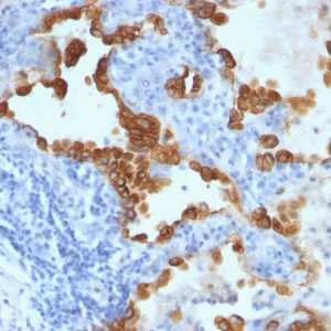 Formalin-fixed, paraffin-embedded human Lung Carcinoma stained with Cytokeratin 8/18 Monoclonal Antibody (B22.1 + B23.1).