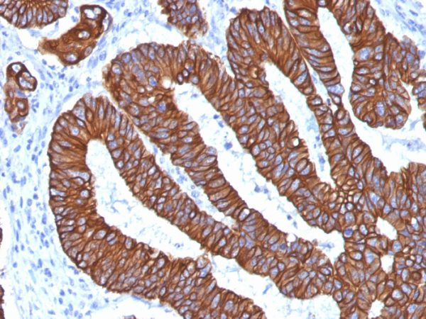 Formalin-fixed, paraffin-embedded human Colon Carcinoma stained with Cytokeratin 8/18 Monoclonal Antibody (KRT8.18/1346).