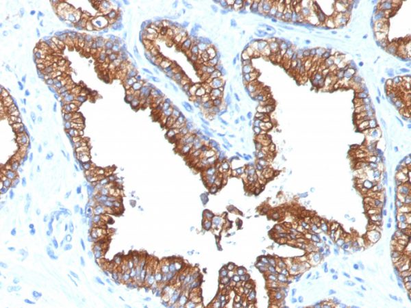 Formalin-fixed, paraffin-embedded human Prostate Carcinoma stained with Cytokeratin 8/18 Monoclonal Antibody (KRT8.18/1346).