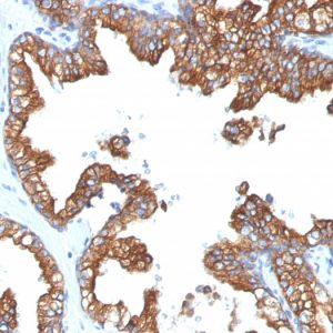 Formalin-fixed, paraffin-embedded human Prostate Carcinoma stained with Cytokeratin 8/18 Monoclonal Antibody (5D3).