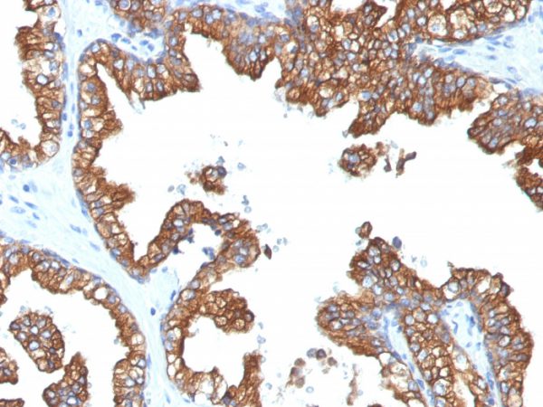 Formalin-fixed, paraffin-embedded human Prostate Carcinoma stained with Cytokeratin 8/18 Monoclonal Antibody (5D3).